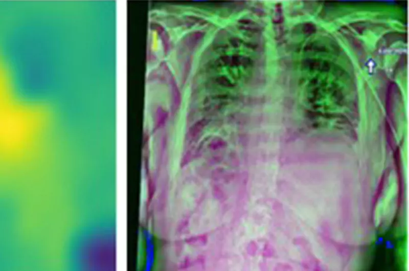 Cardiomegaly_Detection_electrical_engineering_AI
